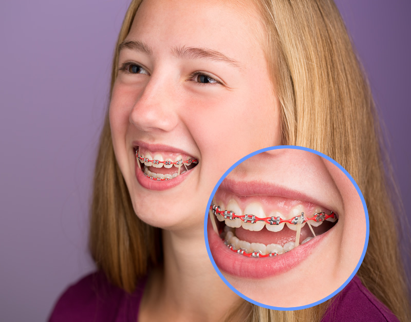 fast braces elastics