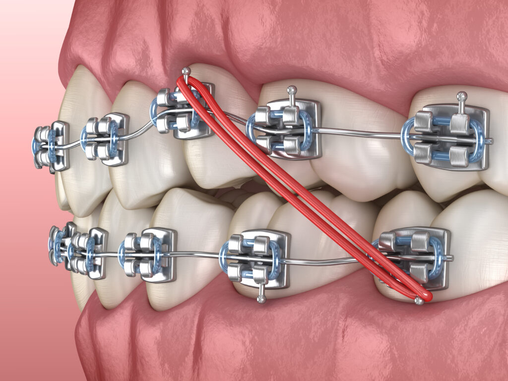 Teeth braces rubber clearance bands