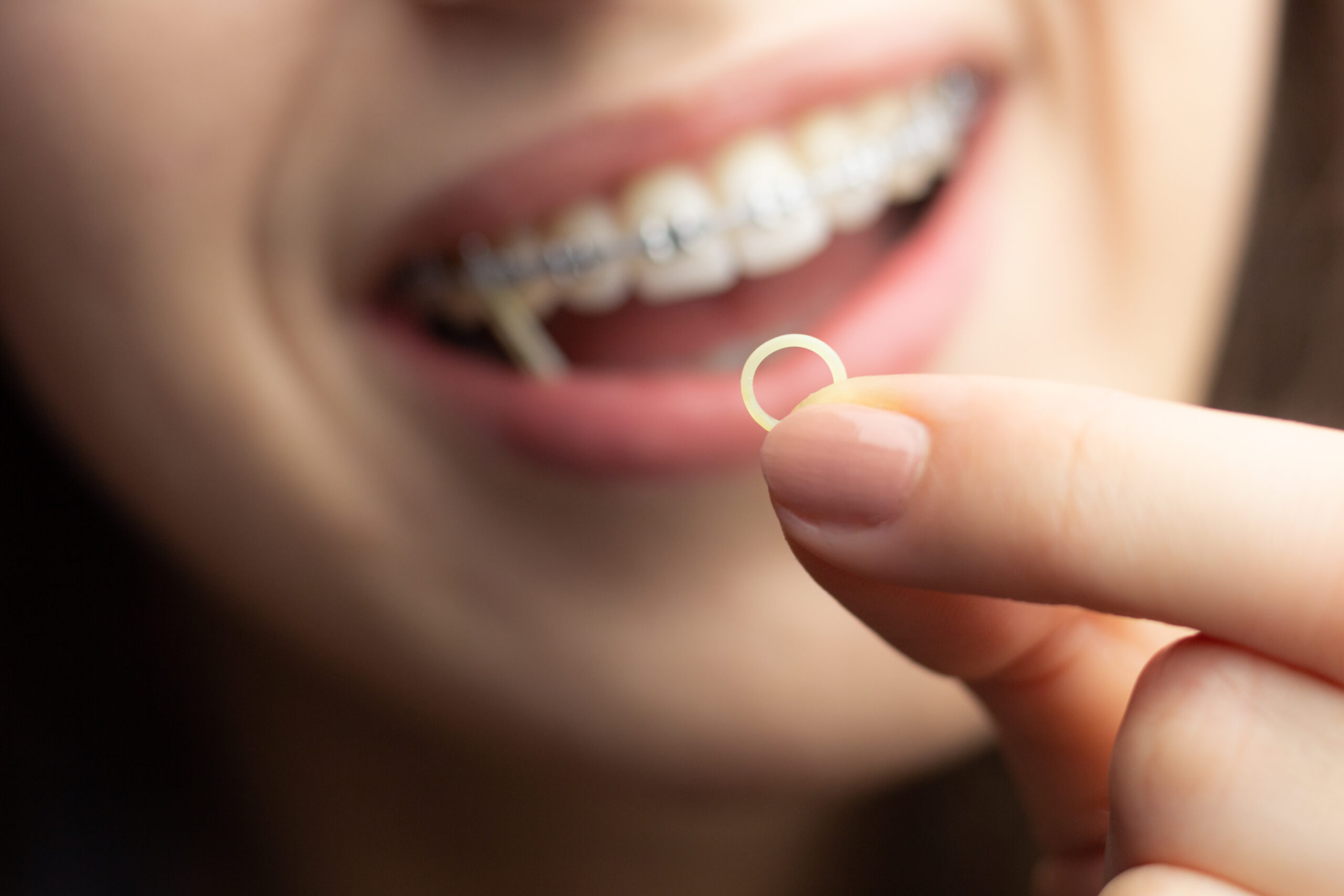 Everything You Need To Know About Rubber Bands For Braces