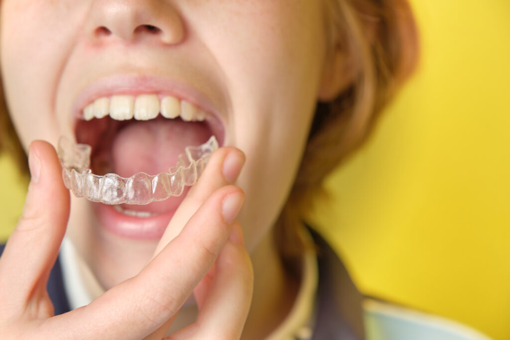 The Best Invisible Braces for Adults in 2023