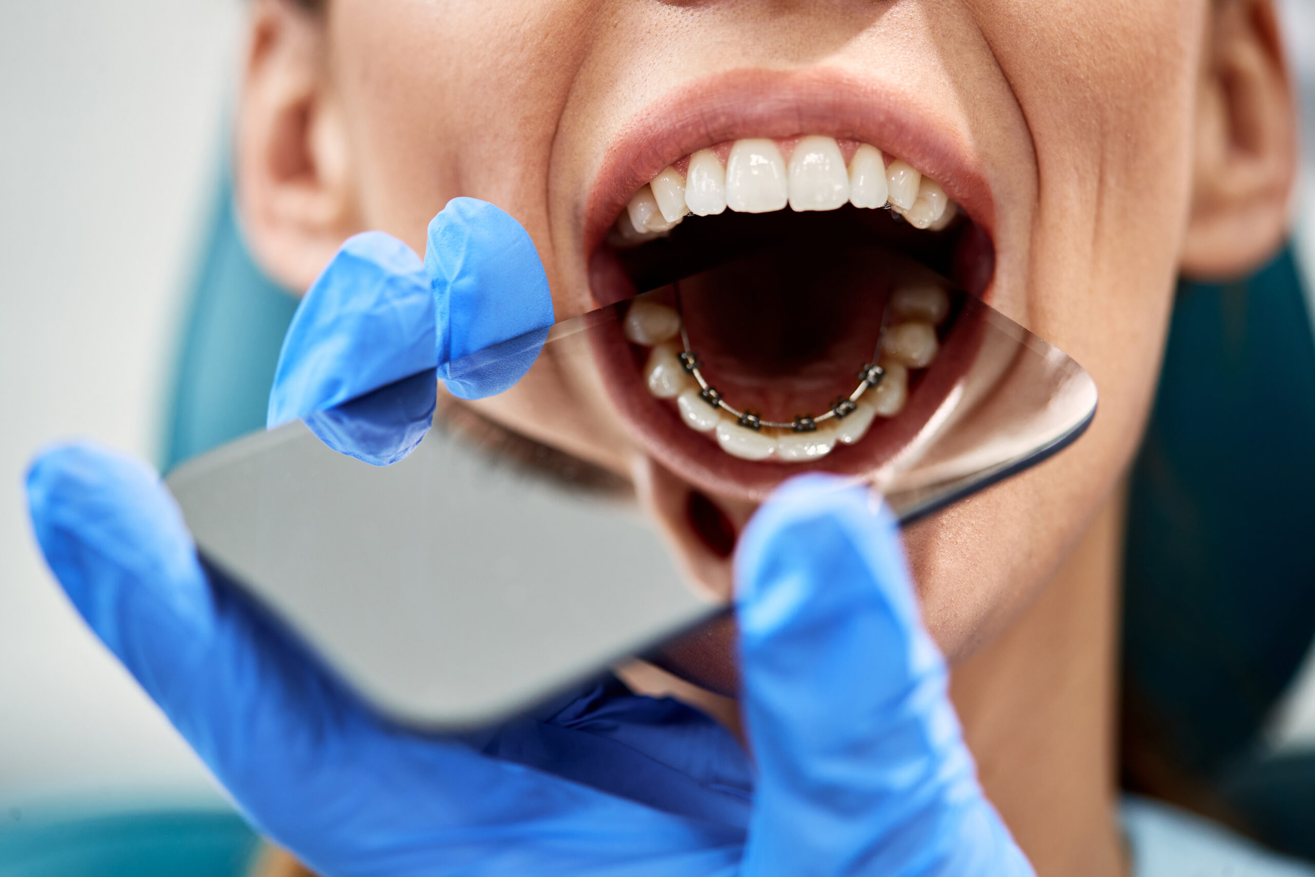 Braces | American Association of Orthodontists