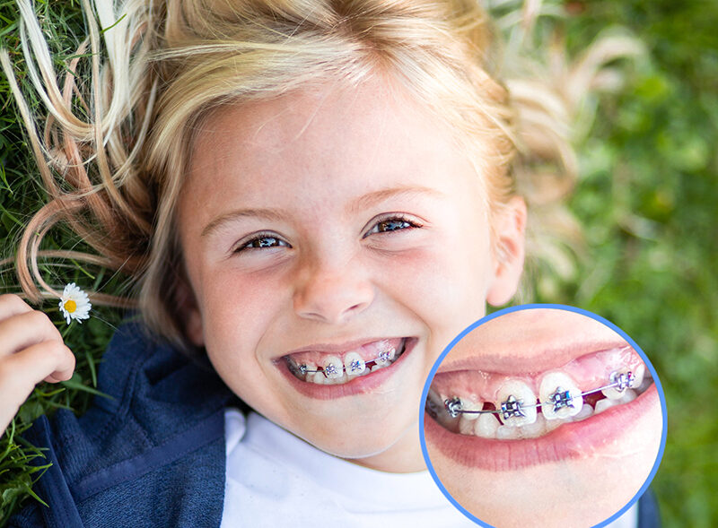 Braces For Teeth Design