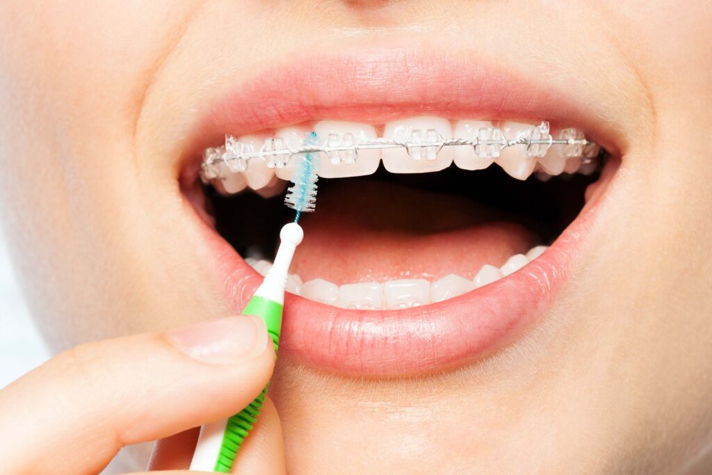 A Guide To Dental Braces: Types and How It Works - CD
