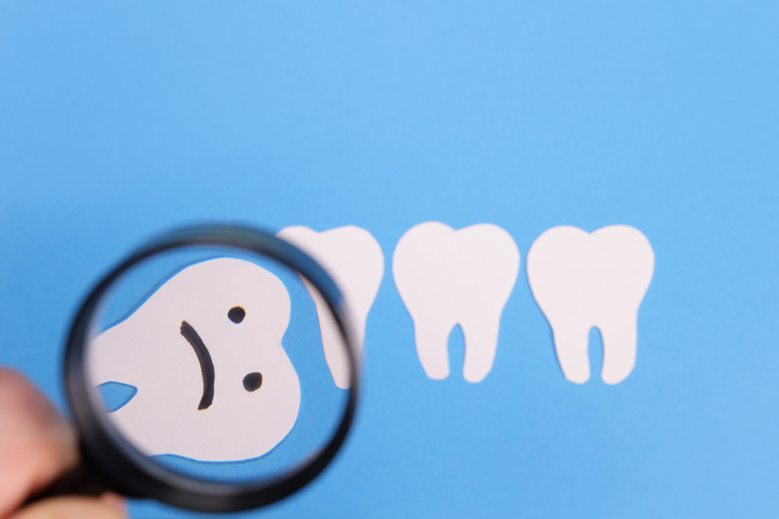 An illustration of impacted teeth, a common dental issue where a tooth fails to break through the gum line, often affecting wisdom teeth or canines, with potential complications if not treated.