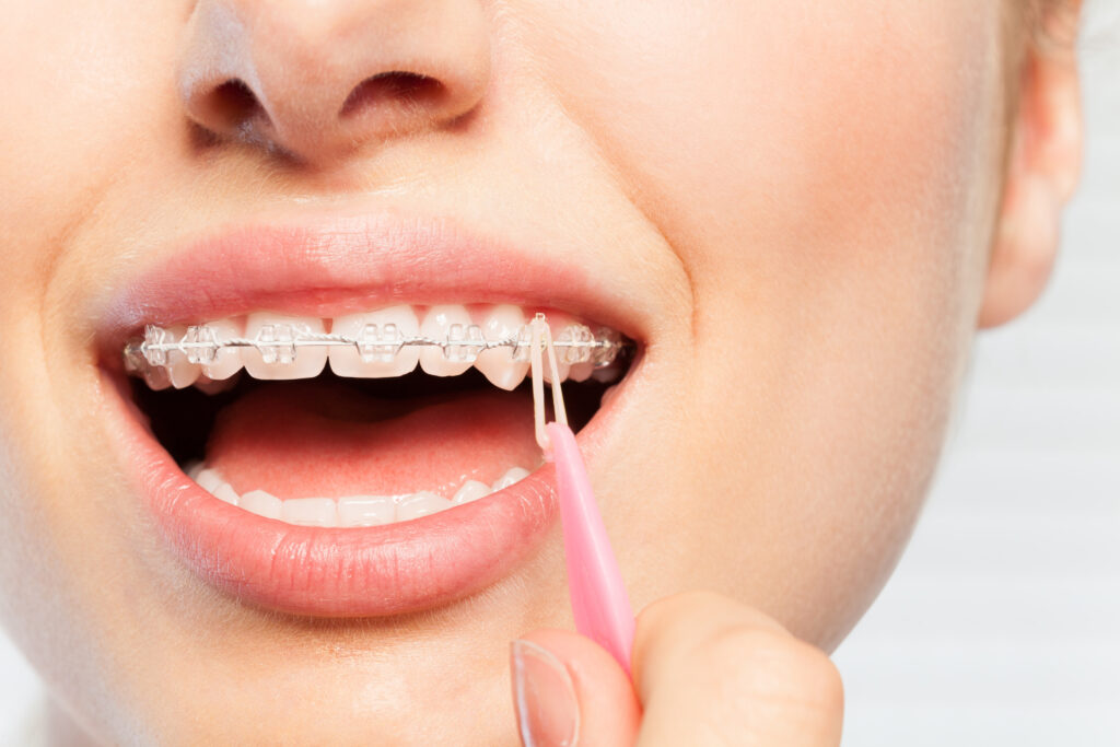 Close up image of a woman attaching a rubber band to her braces using a special tool.