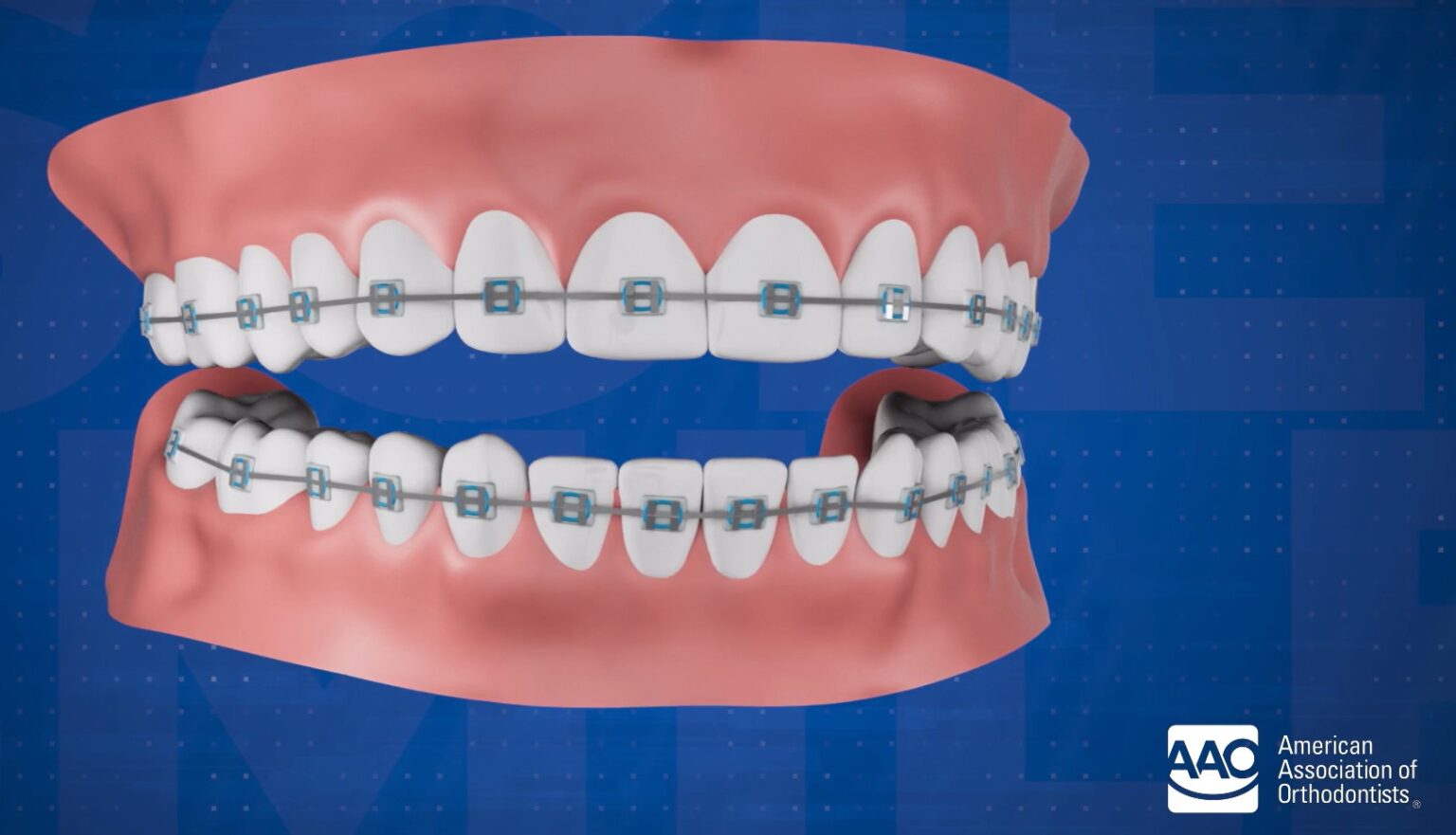 Do Braces Change How You Talk? American Association of Orthodontists