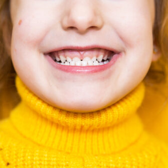 Little girl smiling with an underbite.