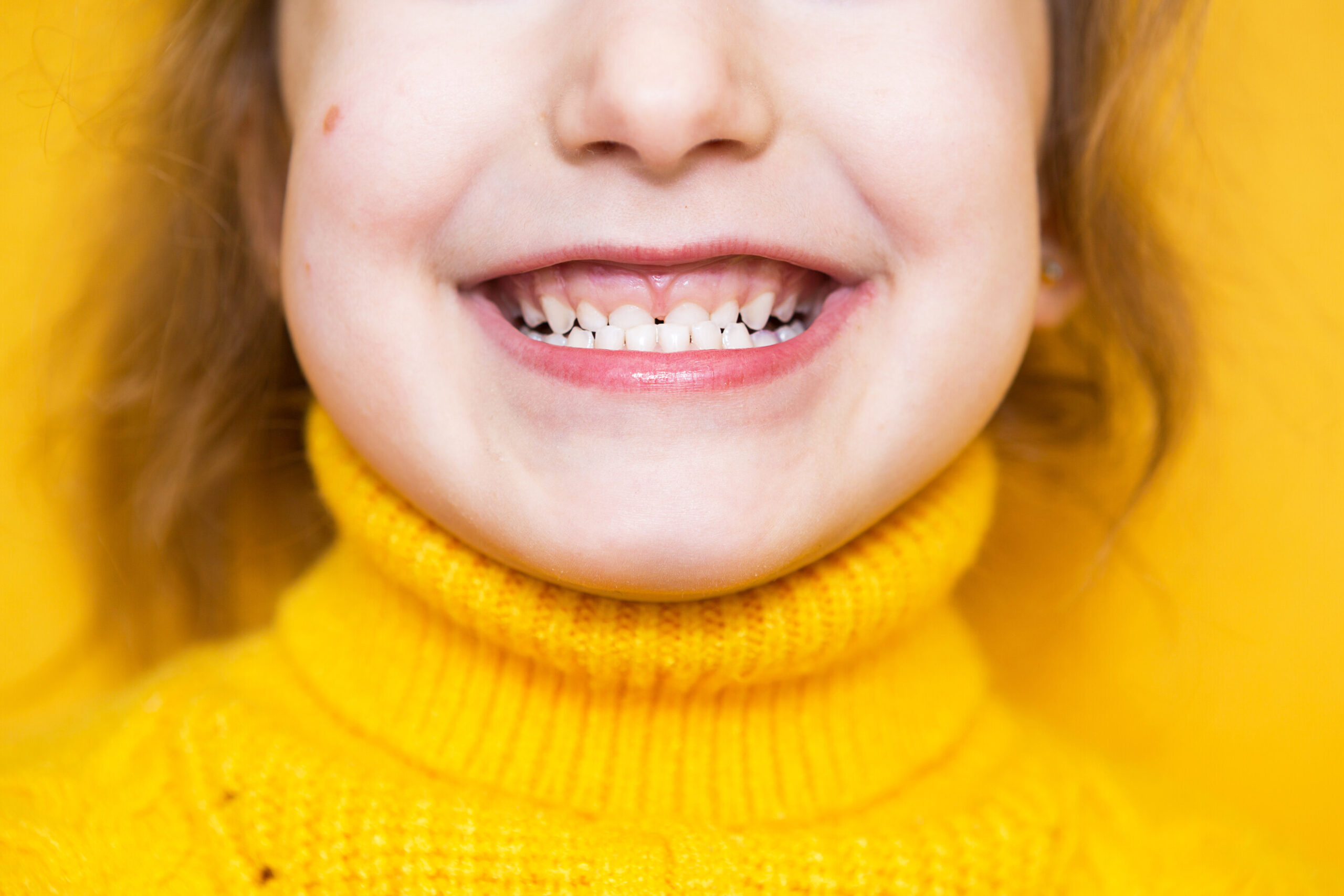 Underbite: Causes, Symptoms, and Treatment Options